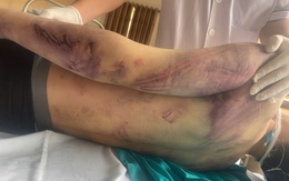 Vụ học viên Trung tâm công tác xã hội Hải Hà bị đánh chết sau 2 ngày nhập học: Tạm giữ 8 người