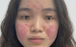 Cô gái trẻ đỏ rát mặt vì ô nhiễm không khí, bác sĩ hướng dẫn cách bảo vệ da