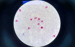 Phát hiện nhanh cứu sống một người đàn ông bị nhiễm não mô cầu