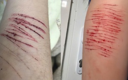 Trẻ có thể tự gây thương tích khi stress, làm sao để giúp trẻ vượt qua?