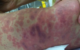 Cảnh báo dịch viêm não mô cầu ở Thái Bình