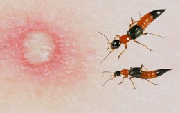 Dùng kiến ba khoang đắp chữa ngứa, nam thanh niên chảy dịch toàn thân