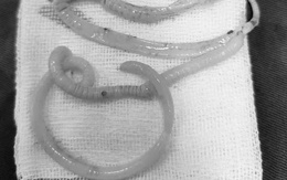 2 con giun đũa dài 25cm đâm thủng ruột non người phụ nữ