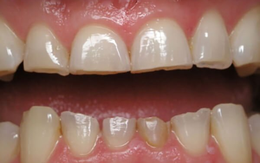 Tật nghiến răng có nguy hiểm?