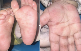 Trẻ 4 tháng tuổi mắc giang mai, ban đỏ nổi rải rác lòng bàn tay, chân