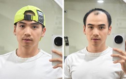 Chồng H’Hen Niê 'khoe' ảnh đầu hói