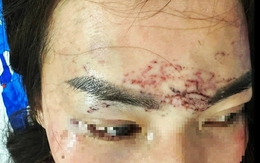 Công an xác minh vụ đánh ghen bằng cách xăm lên mặt ‘tình địch’ xôn xao dư luận ở Cà Mau