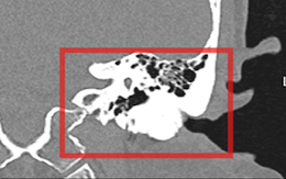 Giảm thính lực do lồi xương ống tai ngoài hiếm gặp