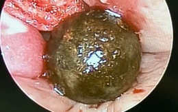 Viên đạn súng bắn chim bị 'quên' trong hốc mũi bé trai