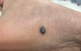 Suýt mất bàn chân vì nốt ruồi nhỏ