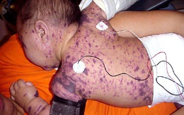 Bệnh não mô cầu dễ lây lan, nguy cơ xuất hiện thêm ca cộng đồng, phòng bệnh thế nào?