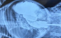 Bé gái 2 tháng tuổi mắc bệnh teo đại tràng bẩm sinh hiếm gặp