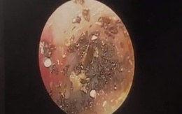 Bác sĩ tá hỏa khi phát hiện ổ ve chó trong tai bé 9 tuổi