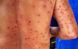 Người đàn ông ở Cà Mau bị ong vò vẽ đốt hơn 100 nốt dẫn đến tử vong