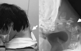 Thanh niên 25 tuổi mắc 'hội chứng cúi đầu' do nhìn điện thoại quá nhiều