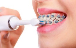 Hai lợi ích ít được biết đến của việc niềng răng