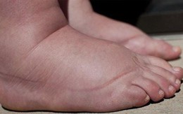 Trẻ đột nhiên bị phù, coi chừng mắc bệnh lý thận nguy hiểm