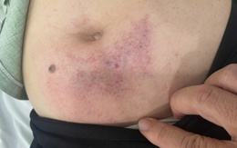 Xác minh vụ cô giáo lớp lá đánh hiệu phó trường mầm non đến nằm viện