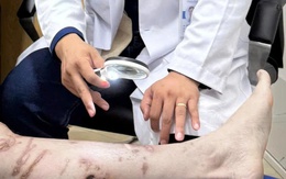 Bội nhiễm, sẹo phì đại vì bị sứa bám khi đang tắm biển