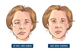 Nhiễm lạnh, trúng gió: Nguy cơ dẫn đến liệt dây thần kinh số 7 ngoại biên