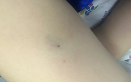 Bé 3 tuổi bị sốc phản vệ độ 3 vì ong đốt