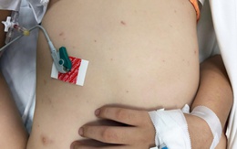 Cảnh báo viêm màng não do vi khuẩn não mô cầu ở trẻ em