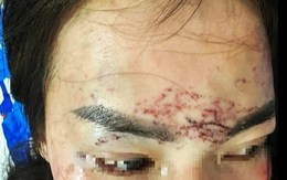 Khởi tố vụ án đánh ghen xăm lên mặt, tạt axit xôn xao dư luận ở Cà Mau