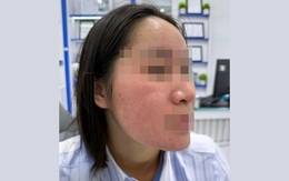 Hết trị bách bệnh, lại rước họa vì dùng nước cốt chanh trị mụn