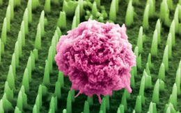 Đột phá trong chẩn đoán ung thư: Miếng dán siêu nhỏ thay thế sinh thiết