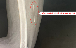 Đau cánh tay không ngờ que cấy tránh thai 'đi lạc' vào cơ bắp