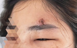 Suýt tử vong vì tự nặn mụn