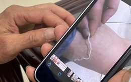 Rùng mình phát hiện giun rồng dài 70cm trong chân