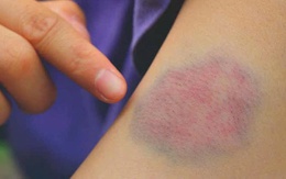 Bỗng dưng xuất hiện vết bầm tím, có thể là dấu hiệu rối loạn tiểu cầu
