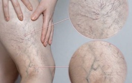 Chân đau nhức, mạch máu lộ rõ cảnh báo bệnh lý đang đe dọa 1/3 người trưởng thành