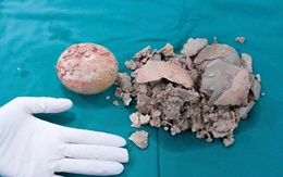 Viên sỏi 'khủng' bằng nắm tay trong bàng quang bệnh nhân 36 tuổi