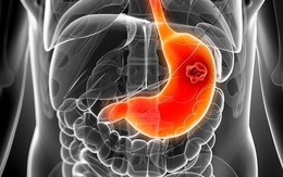 Cách trị viêm loét dạ dày - tá tràng qua bữa ăn