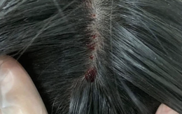 Chích máu đỉnh đầu, dái tai để chữa đột quỵ?