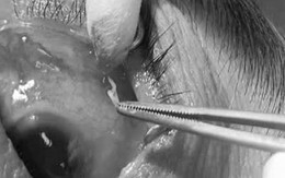 Phẫu thuật gắp con giun đũa dài 4cm trong mắt bệnh nhân