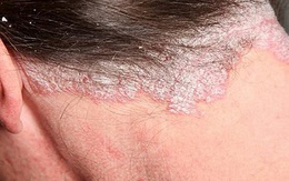 Bệnh vảy nến có thể trị khỏi được không?