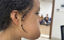 9 giờ liền phẫu thuật miễn phí cho thiếu nữ bị khối u khủng trên mặt