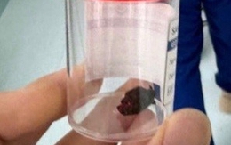 Trẻ suýt mất thị lực vĩnh viễn vì mảnh gỗ dài 1,5cm đâm trúng hốc mắt