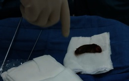 Mổ nội soi cứu bé trai 4 tuổi ở Đồng Nai bị cá rô đồng chui vào cổ họng