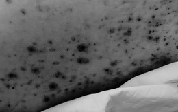 Thanh niên 30 tuổi nguy kịch vì thủy đậu, bệnh tưởng chừng hay gặp ở trẻ em