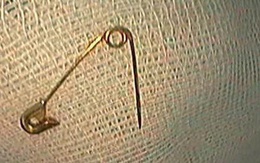 Hoảng hốt tìm cách lấy cây kim băng lại vô tình đẩy dị vật vào sâu trong họng trẻ