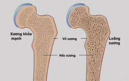 Làm gì để phòng ngừa bệnh loãng xương?