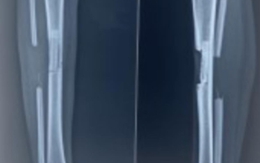 Cô gái chụp X-quang bất ngờ thấy mất xương chân