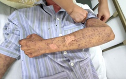 Bị mù tạm thời, bỏng rát toàn thân vì silicon chống dột