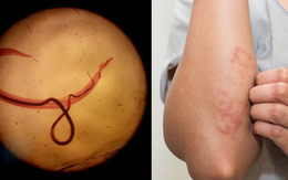 Phát hiện loài sán nguy hiểm biết 'tắt' cảm giác đau ở người