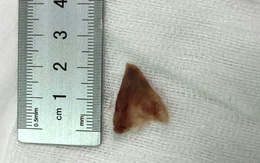 Mắc xương ngại đi bệnh viện, người phụ nữ dùng cách 'vuốt ngược'