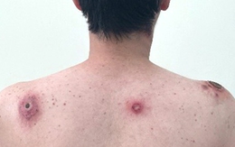 Vết loét tự lành: Dấu hiệu cảnh báo bệnh giang mai?